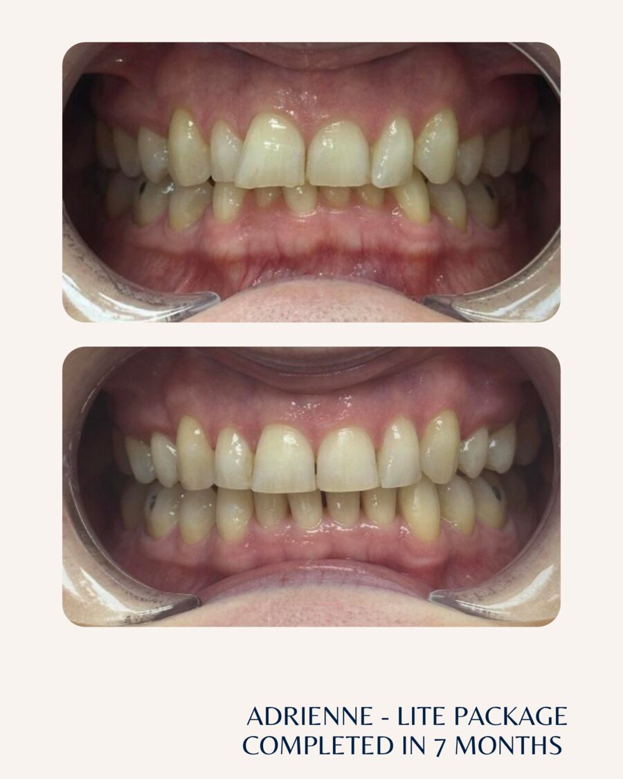 Actual patient before and after Invisalign, case 2