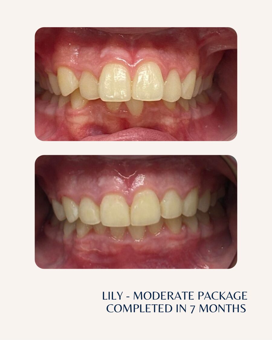 Actual patient before and after Invisalign, case 3