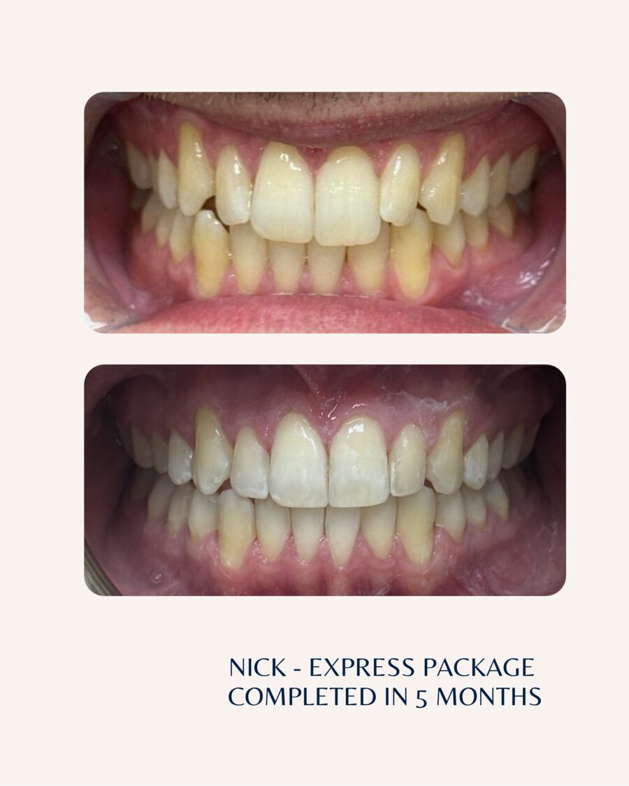 Actual patient before and after Invisalign, case 4