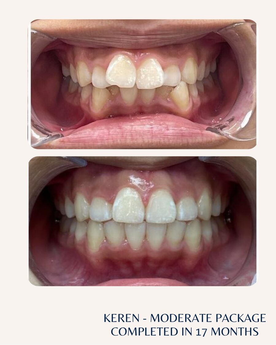 Actual patient before and after Invisalign, case 1